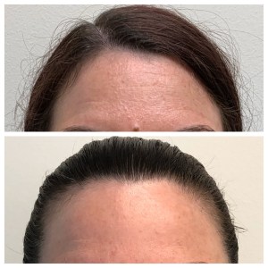 Before/After Facial Rejuvenation