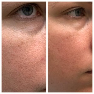 Before/After Facial Rejuvenation