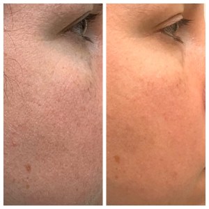 Before/After Facial Rejuvenation